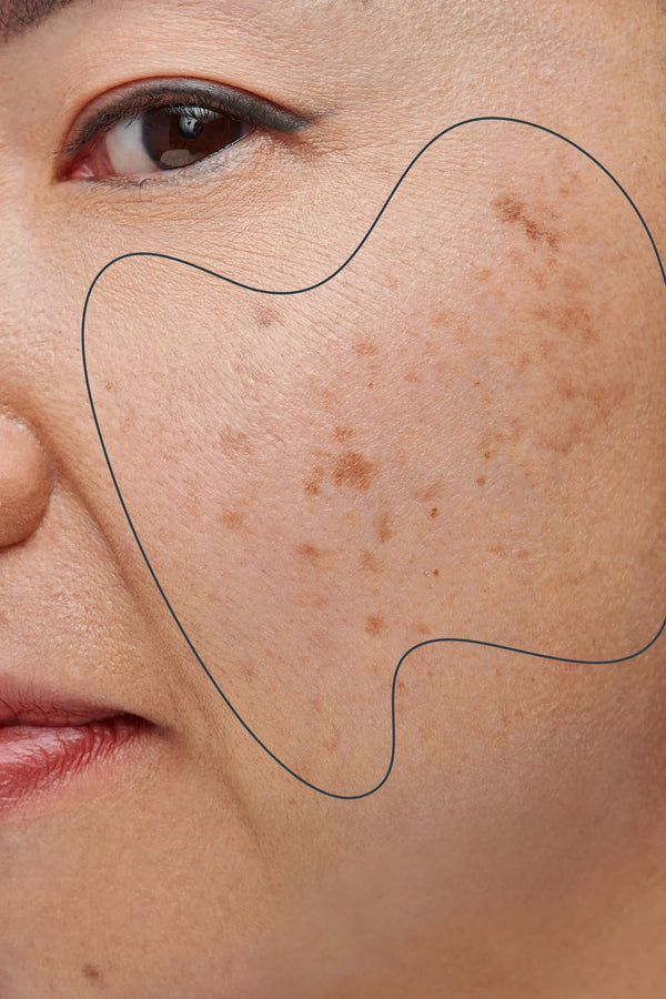 Dark Spots & Hyperpigmentation